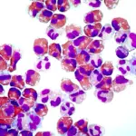 Chronic Eosinophilic Leukemia