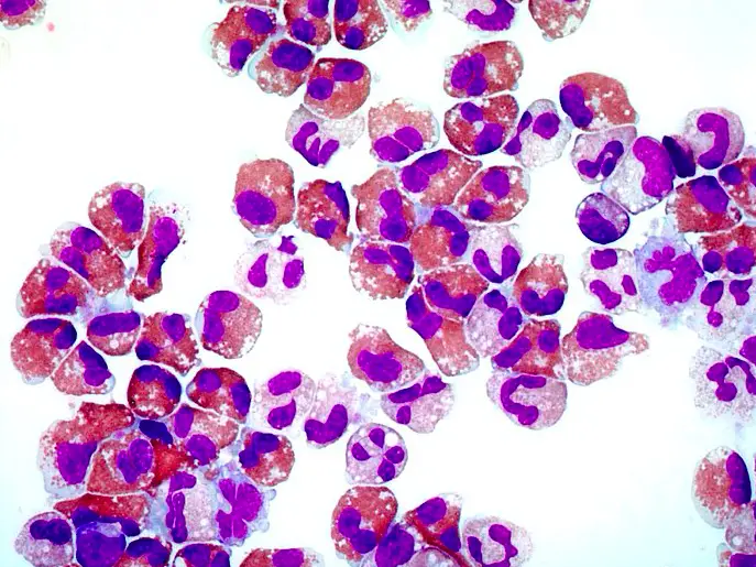 Chronic Eosinophilic Leukemia