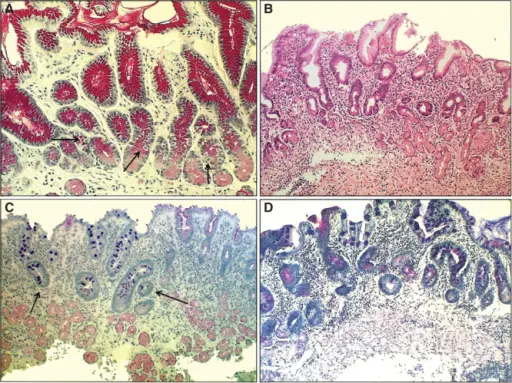 Chronic Gastritis