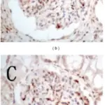 Chronic Glomerulonephritis