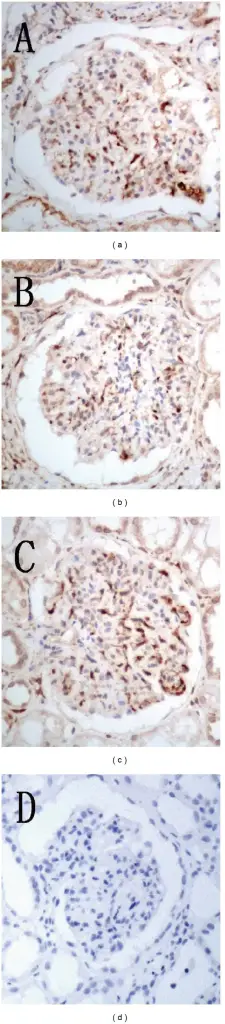 Chronic Glomerulonephritis