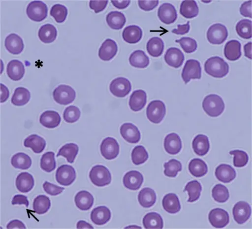 Chronic Immune Thrombocytopenic Purpura