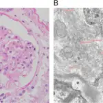 Chronic Inflammatory Demyelinating Polyneuropathy