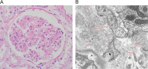 Chronic Inflammatory Demyelinating Polyneuropathy