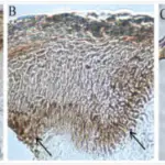 Chronic Inflammatory Dermatoses