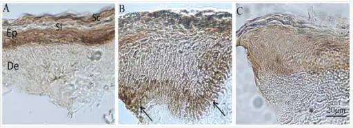 Chronic Inflammatory Dermatoses