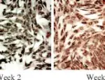 Chronic Ischemic Heart Disease