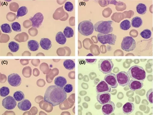 Chronic Lymphocytic Leukemia/Small Lymphocytic Lymphoma