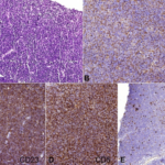 Chronic Lymphocytic Leukemia/Small Lymphocytic Lymphoma