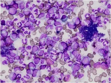 Chronic Myelogenous Leukemia