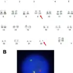 Chronic Myelogenous Leukemia Karyotype