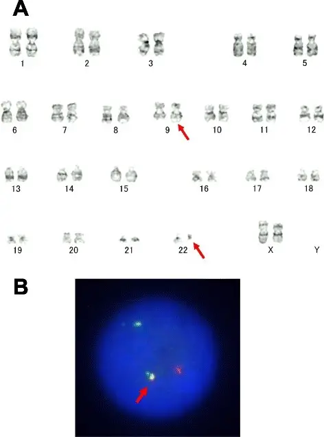 Chronic Myelogenous Leukemia Karyotype