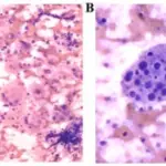 Chronic Nonspecific Lymphadenitis