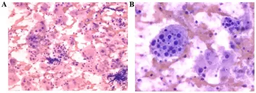 Chronic Nonspecific Lymphadenitis