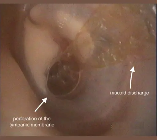 Chronic Otitis Media