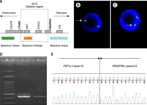 Chronic eosinophilic leukemia