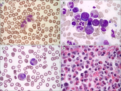 Chronic eosinophilic leukemia