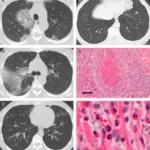 Churg-Strauss Syndrome