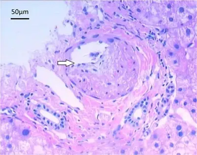 Circulatory Disorders of the Liver