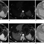 Cirrhosis