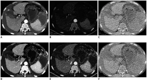 Cirrhosis