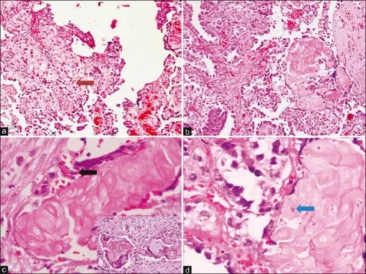 Clear Cell Carcinoma of the Ovary