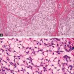 Clear-Cell Odontogenic Carcinoma