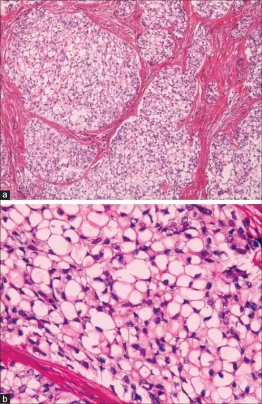 Clear-Cell Odontogenic Carcinoma