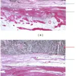 Clear Cell Sarcoma