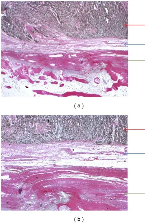 Clear Cell Sarcoma