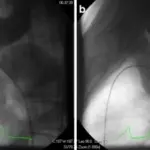 Coarctation of the Aorta