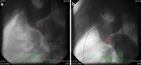 Coarctation of the Aorta