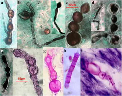 Coccidiomyces Fungal Infection