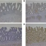 Colitis-Associated Neoplasia