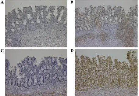 Colitis-Associated Neoplasia