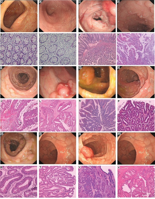 Colonic Polyps