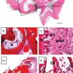 Complex Odontoma