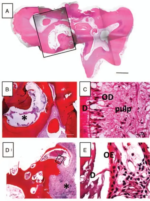 Complex Odontoma