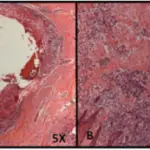 Compound odontoma