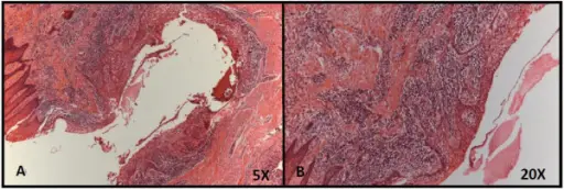 Compound odontoma