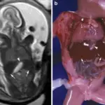 Congenital Abnormalities of the Gastrointestinal Tract