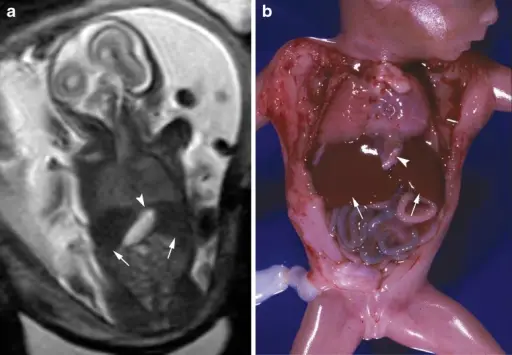 Congenital Abnormalities of the Gastrointestinal Tract