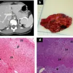 Congenital Adrenal Hyperplasia