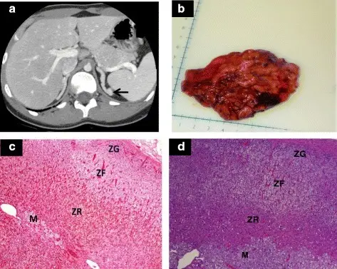 Congenital Adrenal Hyperplasia