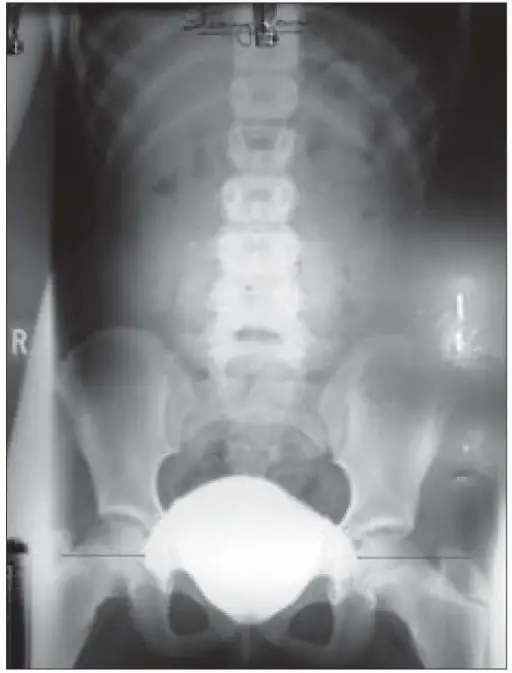 Congenital Anomalies of the Bladder