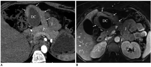 Congenital Anomalies of the Pancreas