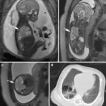 Congenital Anomalies of the Pulmonary System