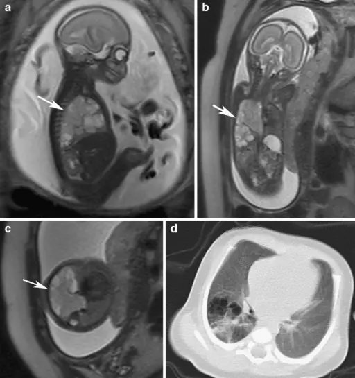 Congenital Anomalies of the Pulmonary System