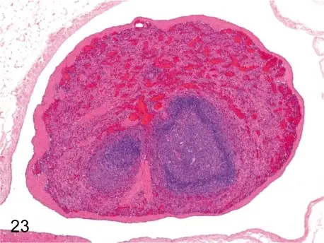 Congenital Anomalies of the Spleen