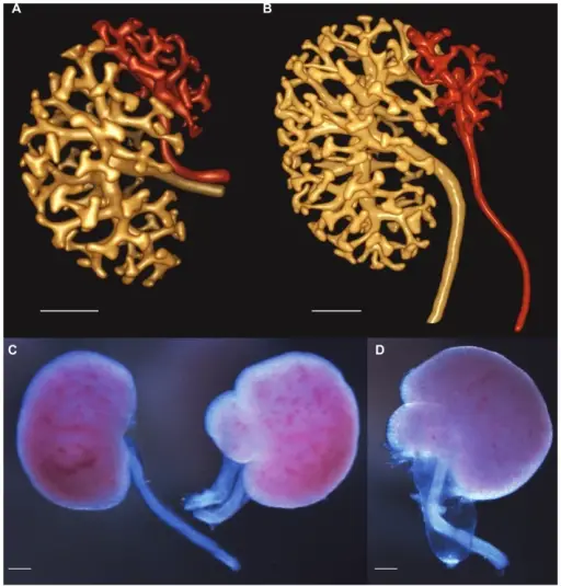 Congenital Anomalies of the Ureters